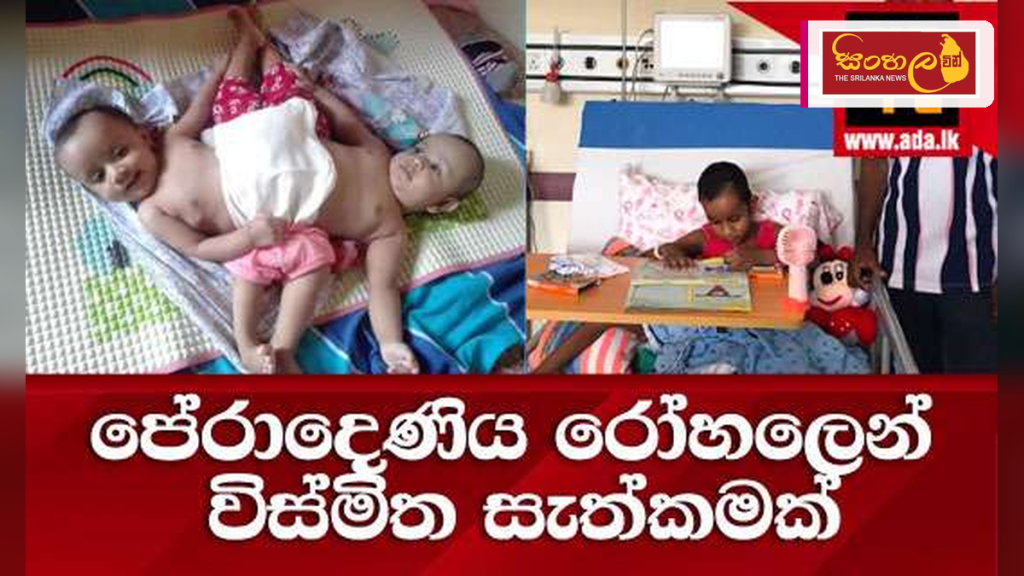 ලොව ප්‍රථම වතාවට පේරාදෙණිය රෝහලෙන් වෛද්‍ය විස්කමක්: බද්ධ වී සිටි නිවුන් දරුවන් වෙන් කෙරේ