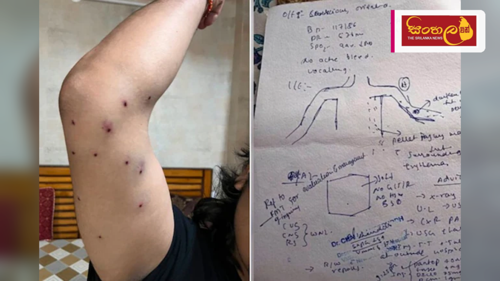 ඉන්දීය විරෝධතාවකදී පෙලට් තුවක්කු භාවිත කළ බවට රෝහල් වාර්තාවකින් හෙළිදරව්